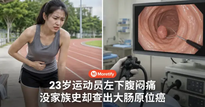 23岁运动员左下腹闷痛 没家族史却查出大肠原位癌