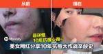 10年抗痘大作战终于成功!美女网红勇敢揭露辛酸史,她试尽无数方法,最后竟靠猜不到的方式解决了